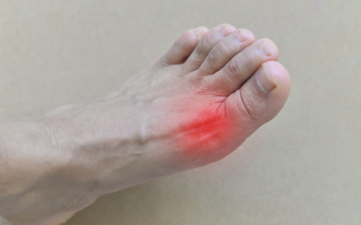 How a Registered Dietitian Can Help You With Gout