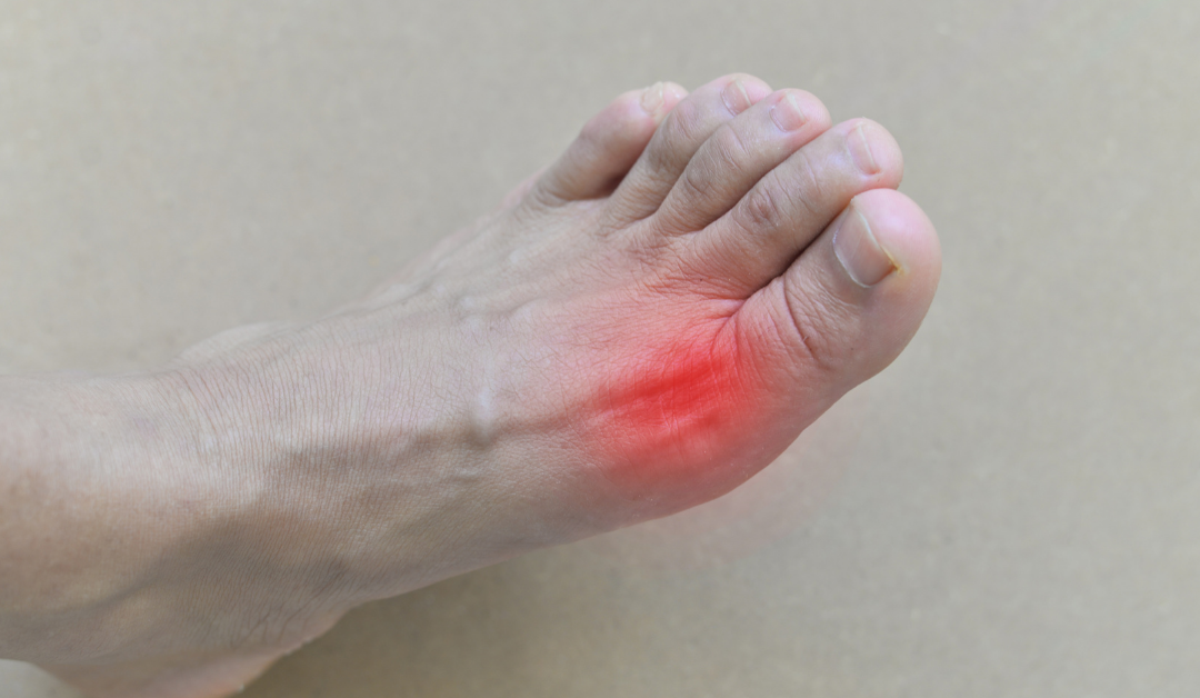 How a Registered Dietitian Can Help You With Gout